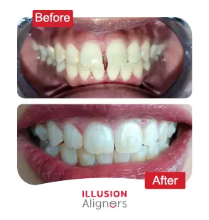 Illusion Aligners
